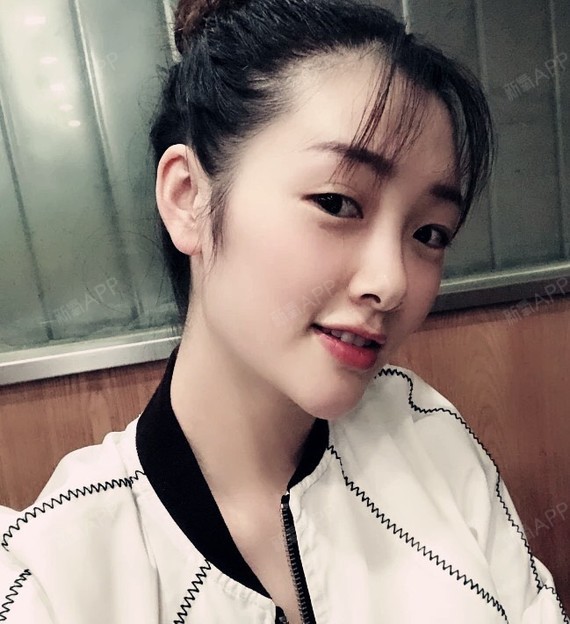 激光祛斑好不好_效果图_氧气103ls激光祛斑术