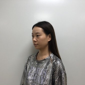 温州美域高医疗美容埋线隆鼻怎么样_恢复过程_效果如何_氧气3mche整形