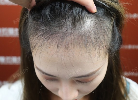 亚美植发宁波(佳美植发医院怎么样)