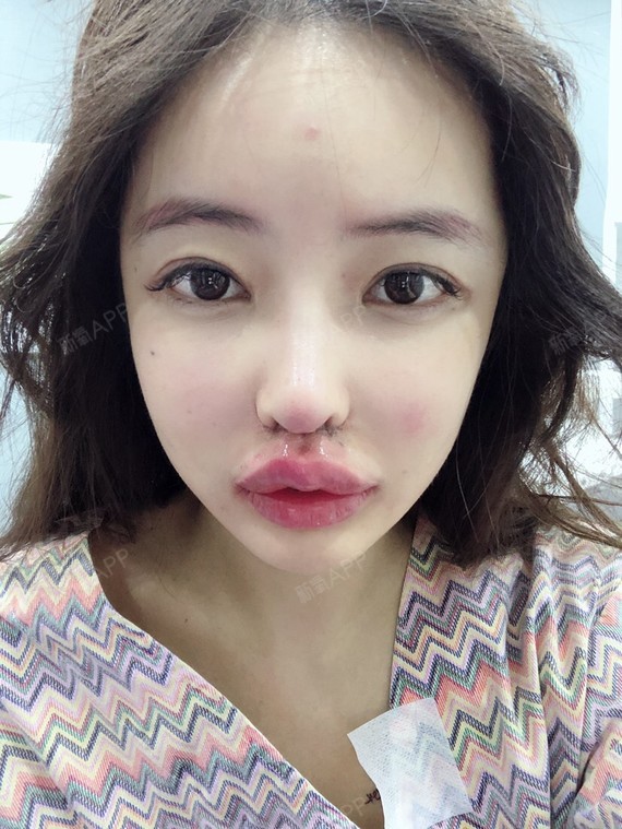 人中缩短术