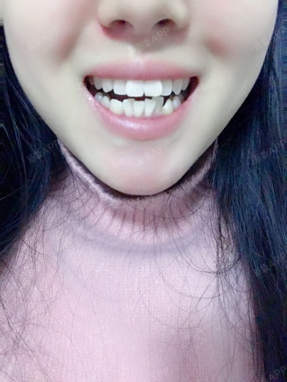 我做牙齿矫正的初衷是因为上门牙"外飘",下牙排列不_圈子-新氧美容
