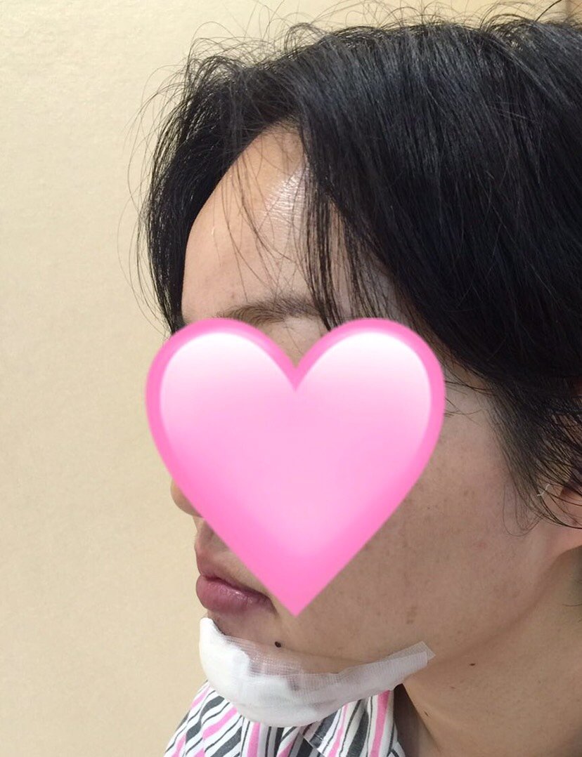 两年前在朋友那儿打了"玻尿酸",已经证实是微晶瓷!