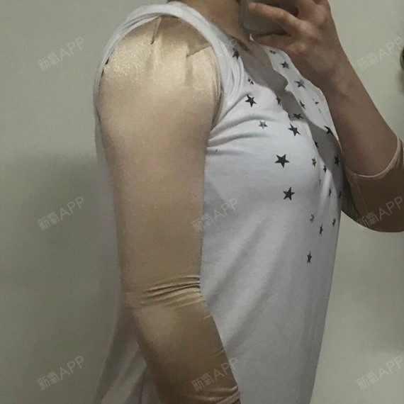 吸脂瘦手臂好不好_效果图_四季冰淇淋吸脂瘦手臂术后第7天_新氧美容