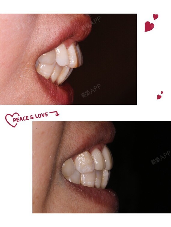 8天时间结束案例方案查看全瓷牙牙齿美容轻度疼痛牙齿修复违法和不良