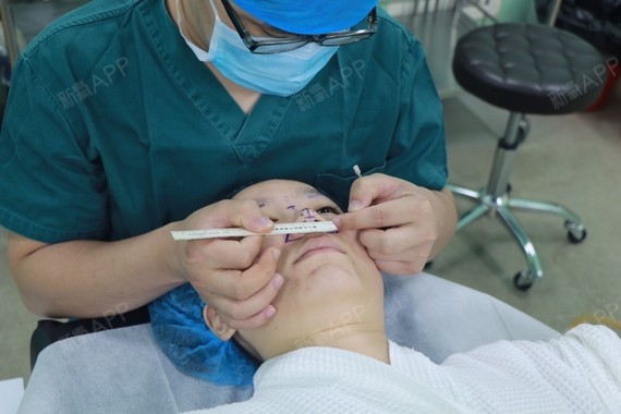 分享我在北京悦丽汇找姚然院长做的鼻基底的填充吧