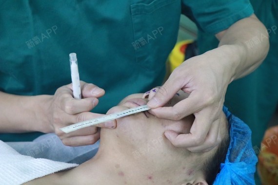 大家好我现在给大家分享一个我在北京悦丽汇做的鼻基底填充的手术吧