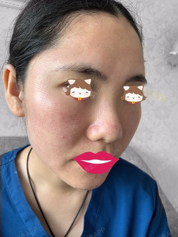 【悦可医美】【黄金微针第1天】