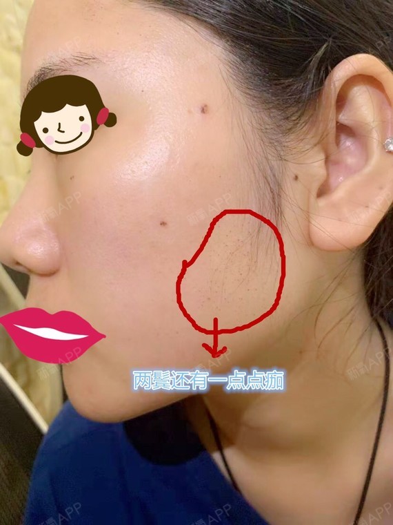 【悦可医美】【黄金微针第3天】