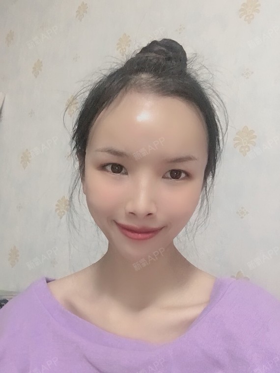 眉间,额头饱满看着就比较舒服98 期待恢复_圈子-新氧美容整形