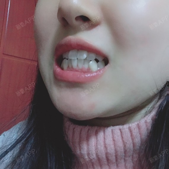 带了差不多一个多月的上牙套,今天终于要去戴下牙