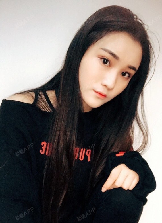 自体脂肪丰卧蚕好不好_效果图_爱做梦的小飞飞自体脂肪丰卧蚕术后第13