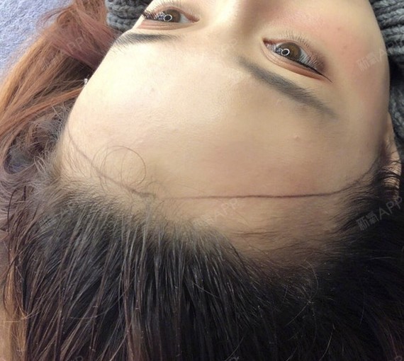 半永久纹发际线