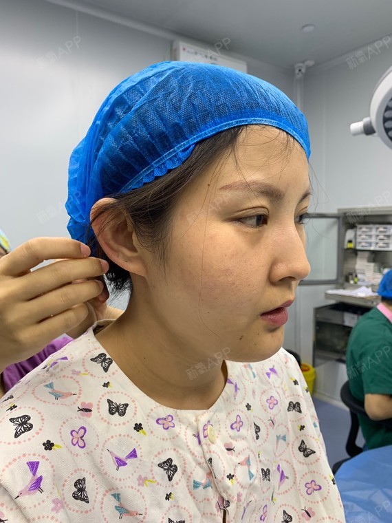 小切口拉皮手术第四天,脸部一周裹了起来,除了肿,没_圈子-新氧美容