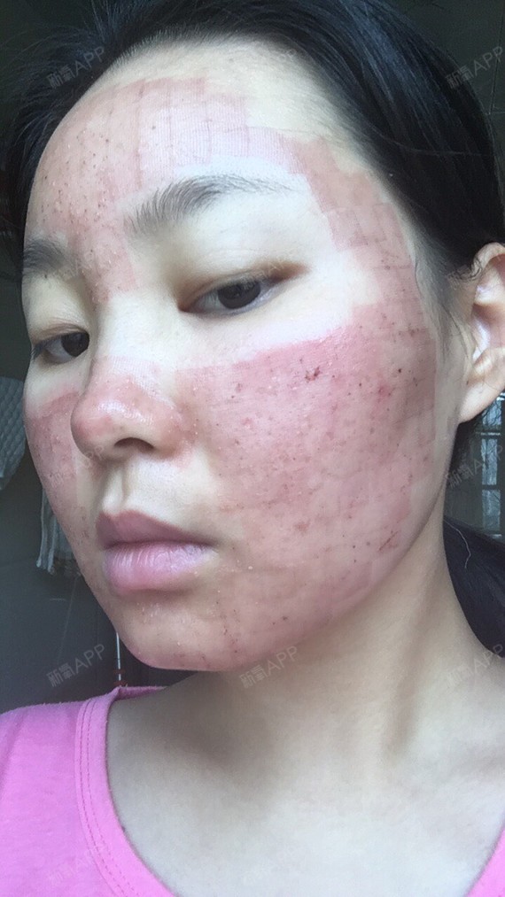脸上结痂了,冒了一点小白头,做治疗的地方都涂上了生_圈子-新氧美容