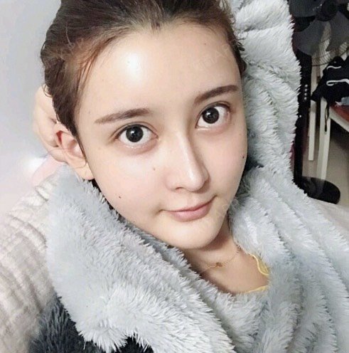 自体脂肪填充卧蚕
