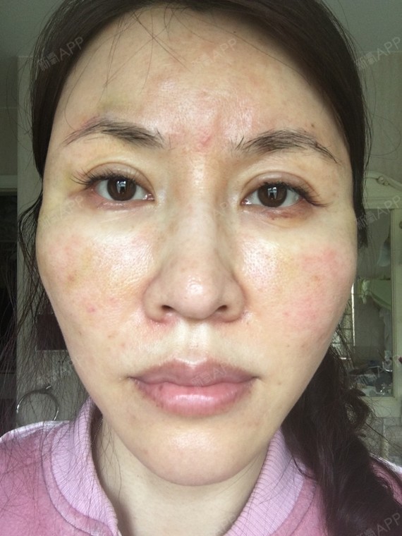 术后第4天,吃着消炎药和消肿药,但脸上青肿的状况没_圈子-新氧美容