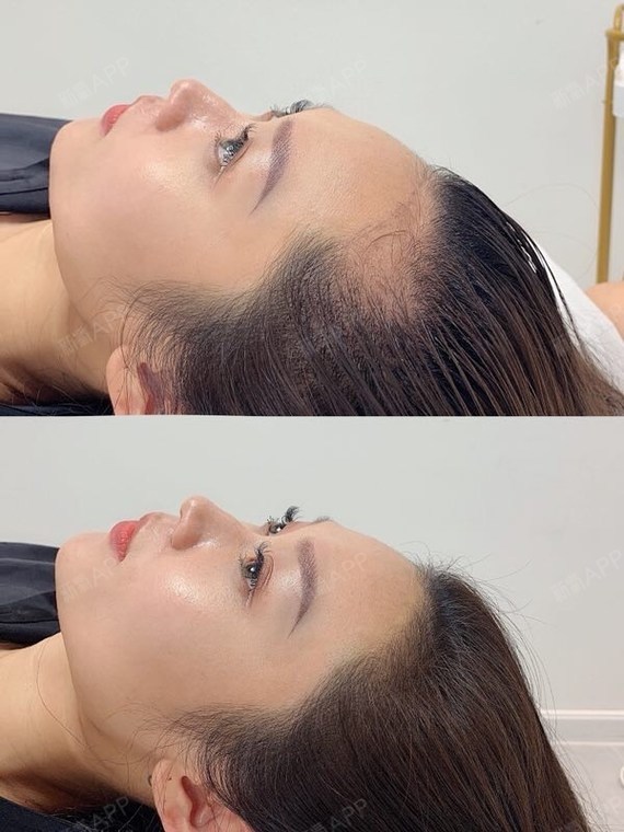 北京半永久纹发际线好不好_效果图_氧气4i4yq半永久纹发际线术后第0天