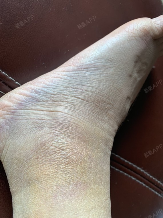 不知道为什么会淤青.照片上看不_圈子-新氧美容整形