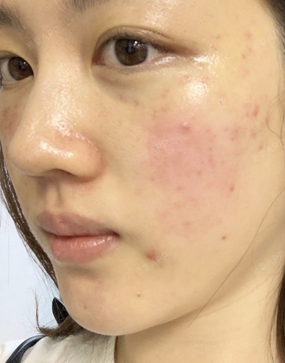 通过新氧消费方案查看皮秒激光光电轻度疼痛祛斑