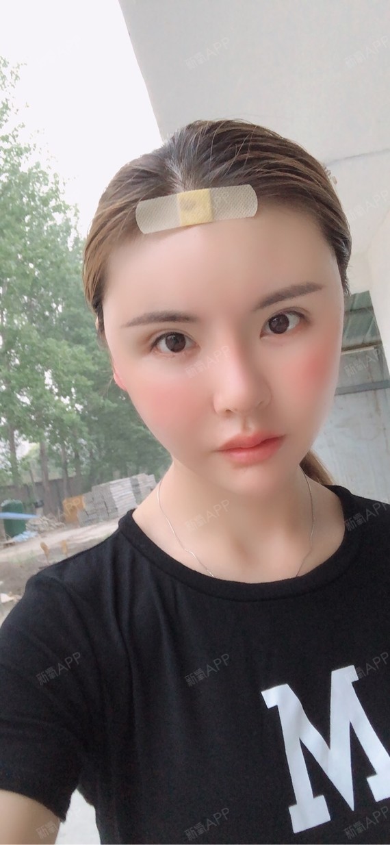 许昌自体脂肪全脸填充好不好_效果图_路要一步一步的走自体脂肪全脸