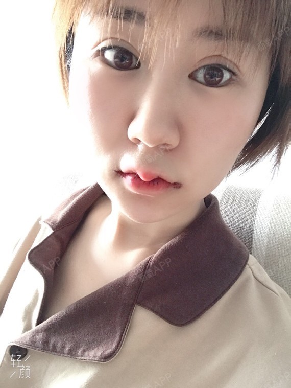 m唇手术