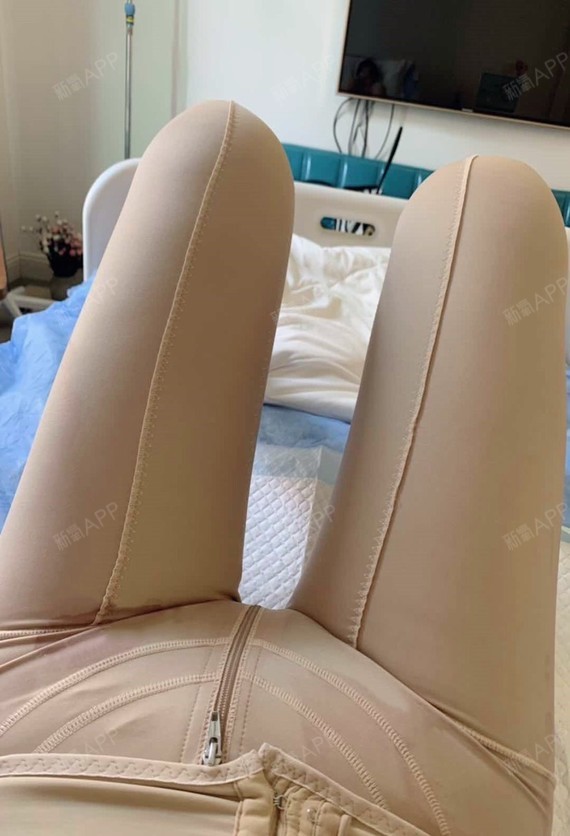 青岛华颜美黄金微雕瘦大腿术后第6天