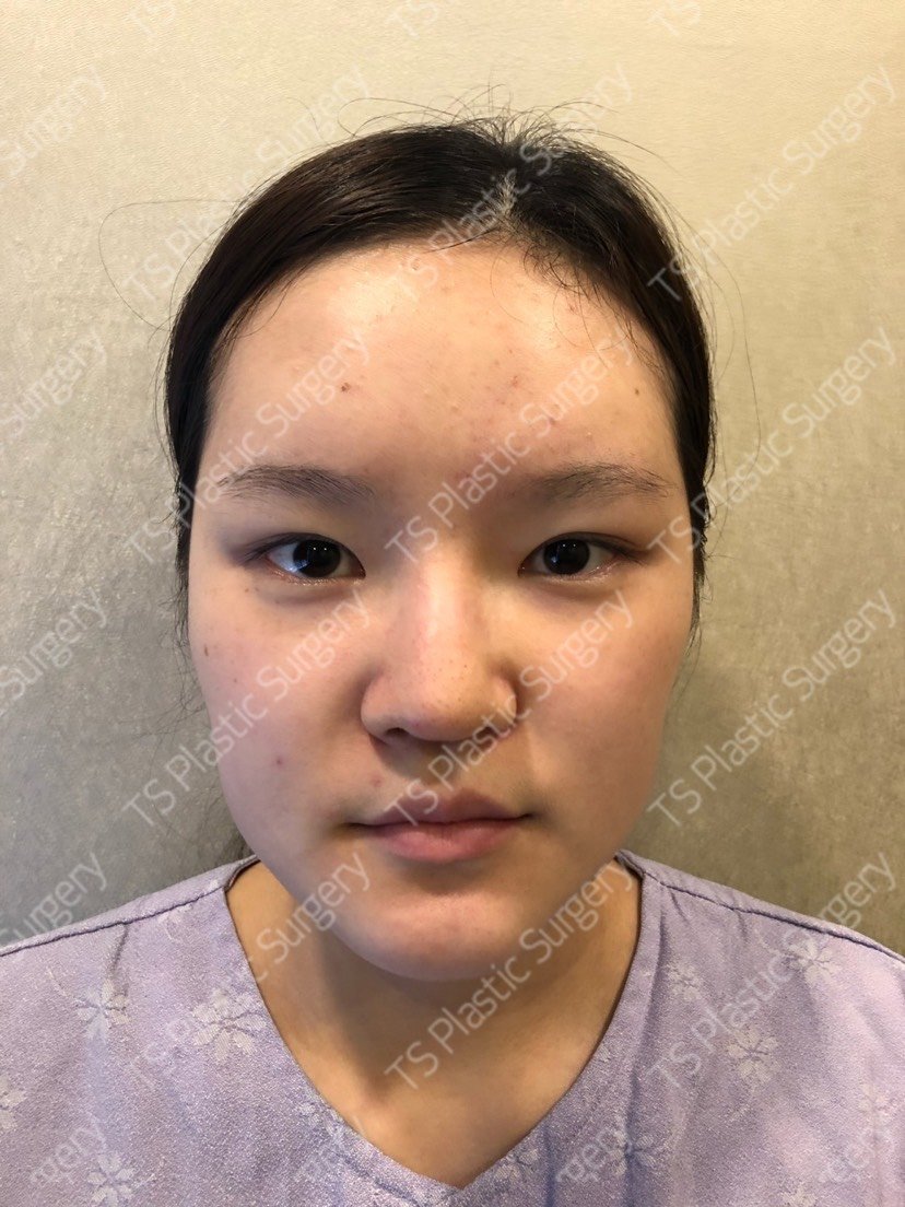 【面部轮廓】颧骨颧弓整形术