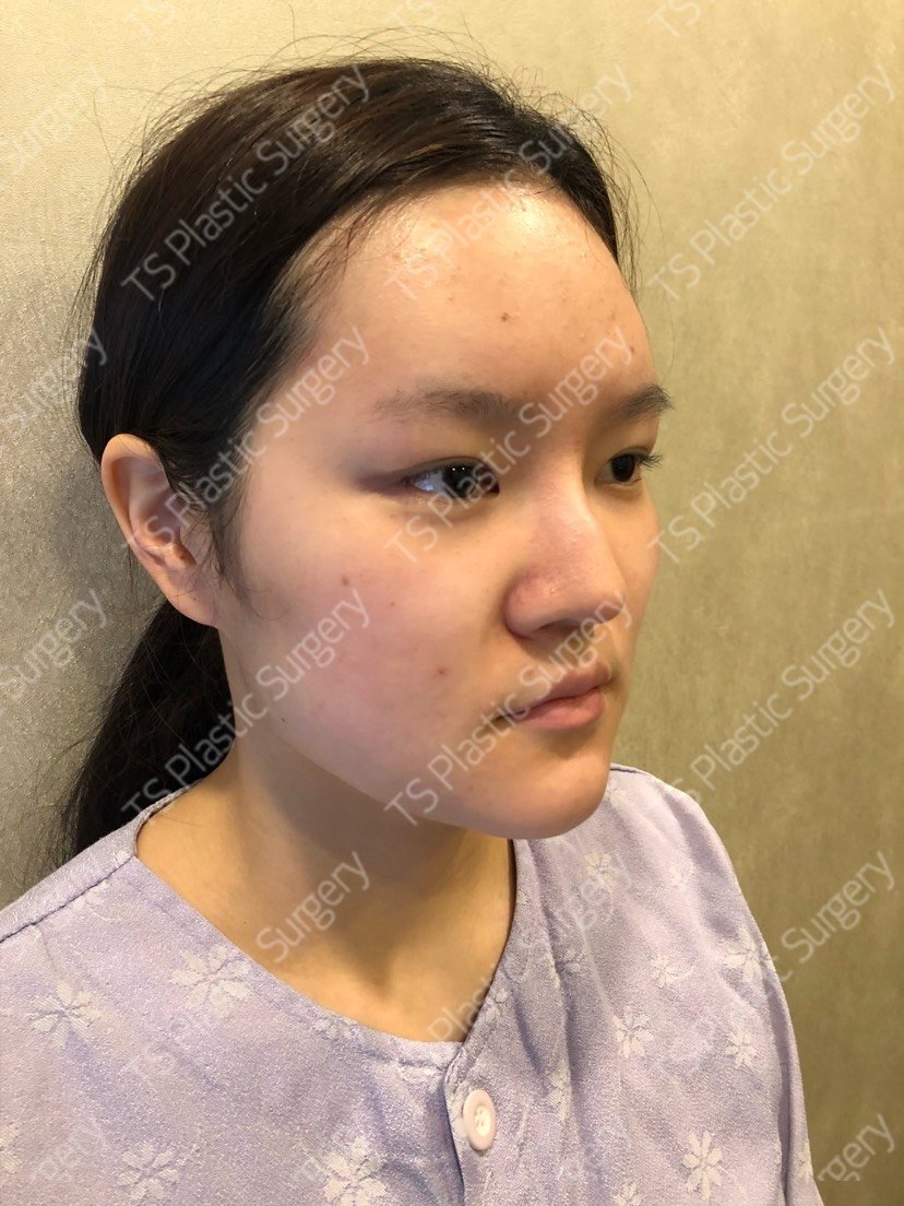 【面部轮廓】颧骨颧弓整形术