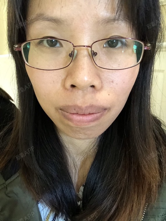 因为我嘴巴凸,从小就有一些奇怪的外号,什么"龅牙妹_圈子-新氧美容
