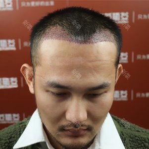 r哥植发视频(最新植发技术视频)