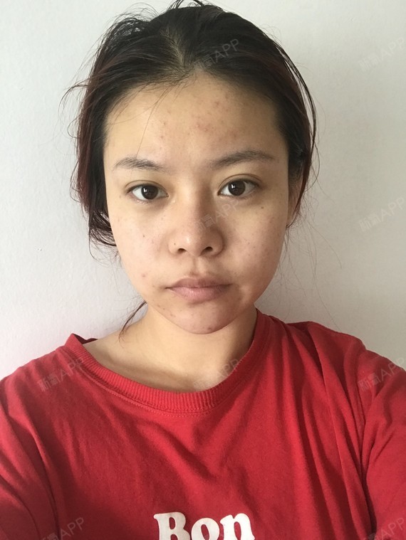 一般瘦脸针需要打几次_瘦脸针打一次就够了吗_瘦脸针要打几次才有效果