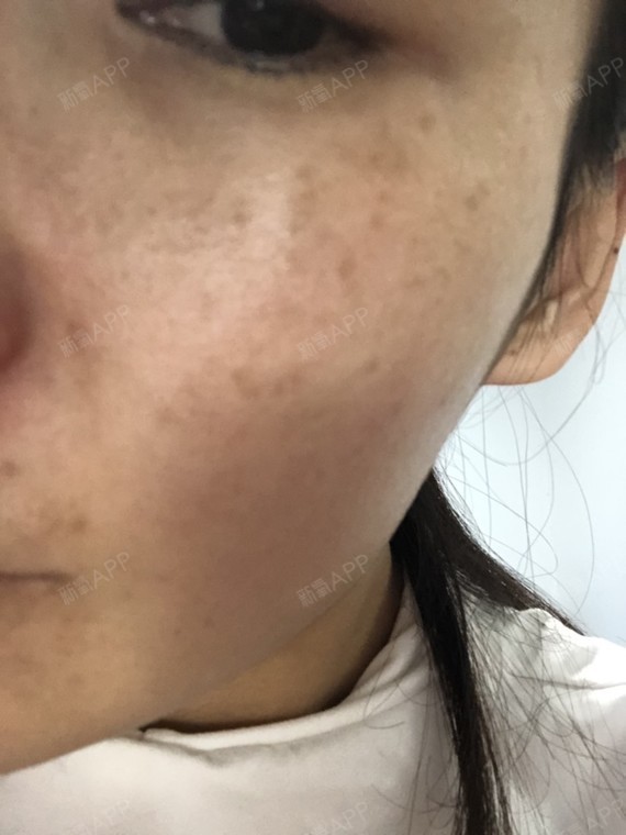 超皮秒四十多天,越来越严重,而且比以前斑更大更多,_圈子-新氧美容