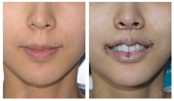 宝宝们我也来记录我的唇综合手术啦!