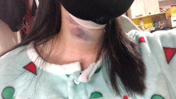 今天我的脖子居然青了这么大一块…… 唉唉睡醒之后吓_圈子-新氧美容