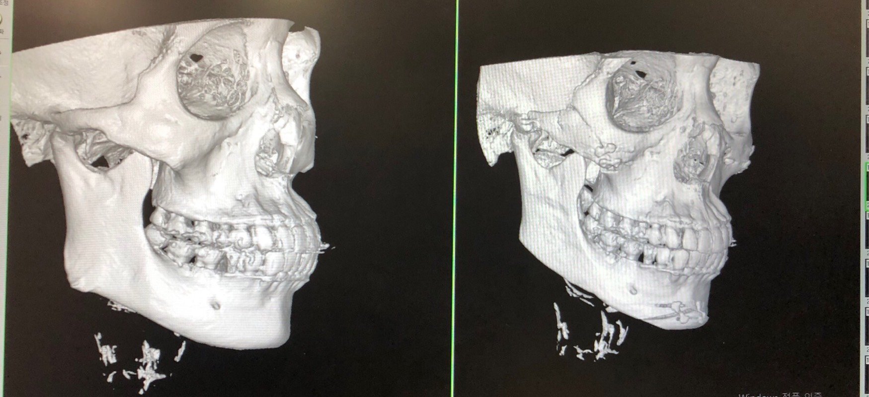 颧骨颧弓整形术第49天