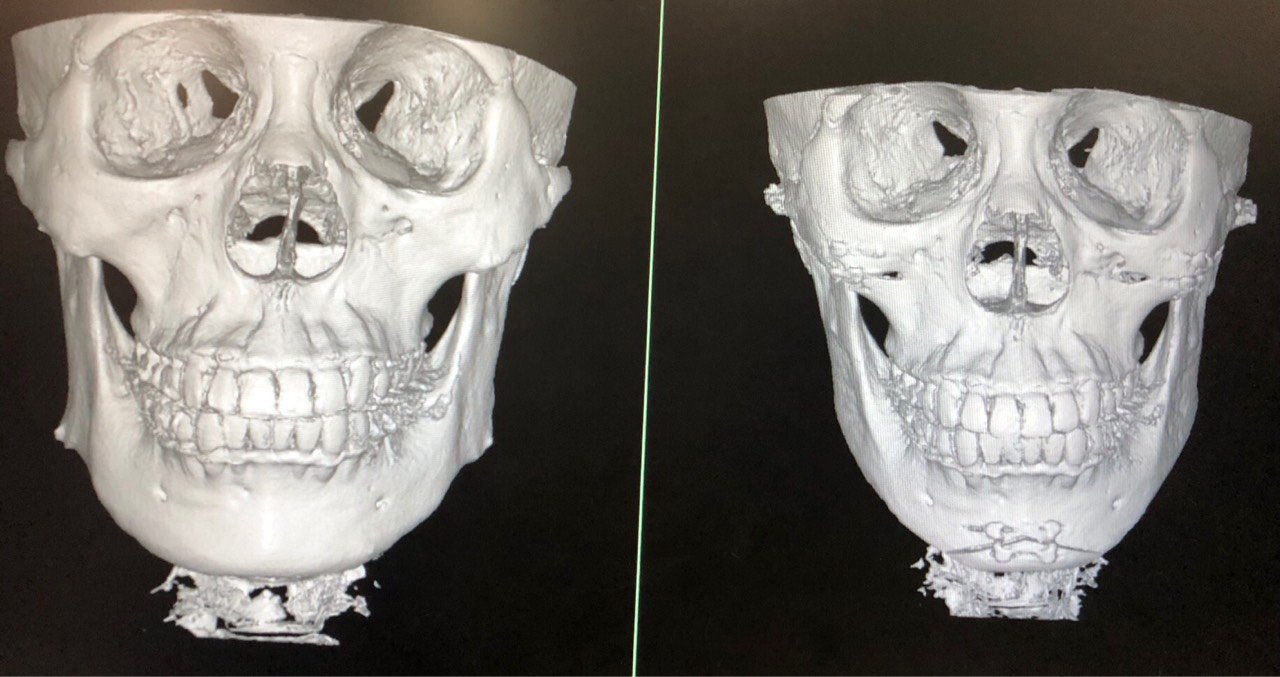 颧骨颧弓整形术第49天