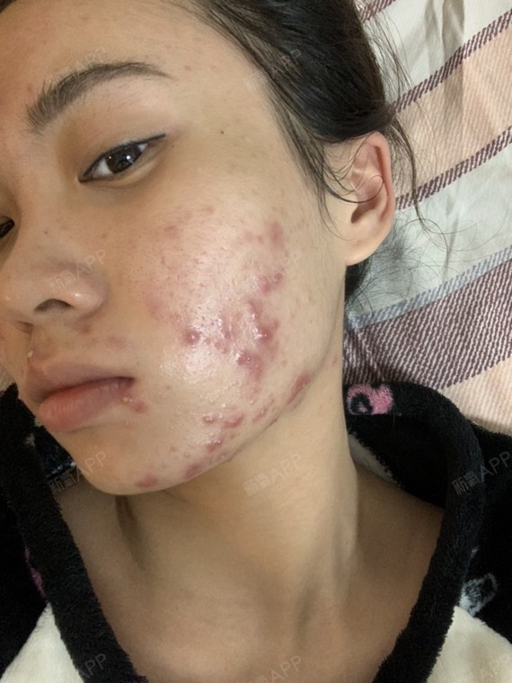 水光补水后爆痘,一天比一天严重_圈子-新氧美容整形