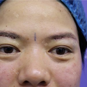 【孔院长-切眉术】