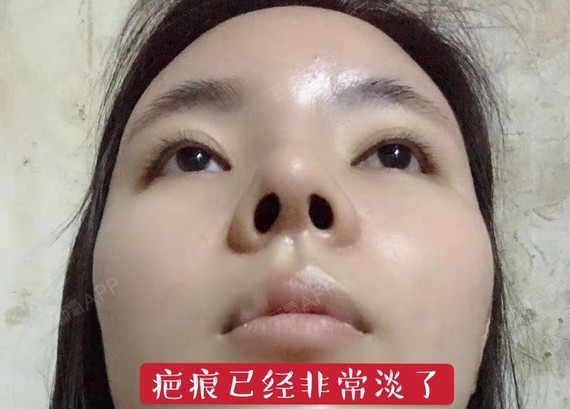 分享一组素颜照,鼻子真的很好看,而且鼻小柱的疤痕已_圈子-新氧美容