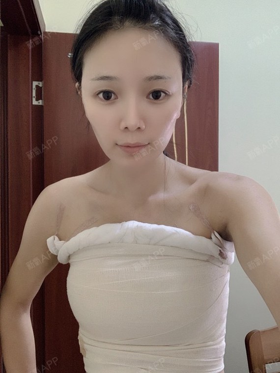 之前是真的很瘦一直都胸小没得多余的脂肪填只能考虑的就是假体了包括