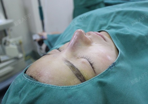 手术延长鼻小柱