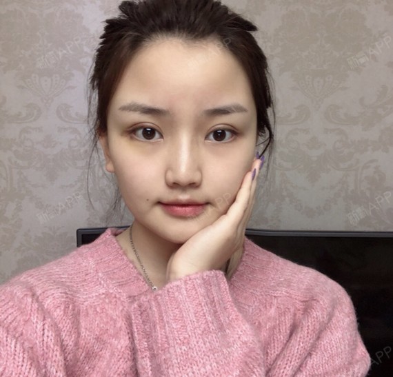 我割的是8毫米双眼皮,但是医生说其实这个数字没有多_圈子-新氧美容