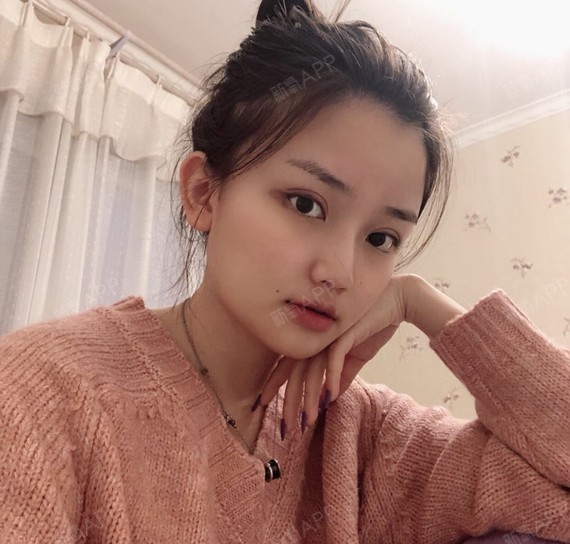 我割的是8毫米双眼皮,但是医生说其实这个数字没有多_圈子-新氧美容