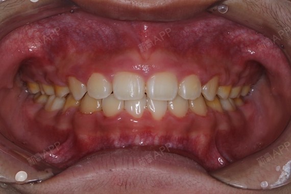 因为听说传统的牙套会比隐形的牙套时间短,唯一的缺点就是不太美观