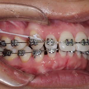 20"金属托槽矫正