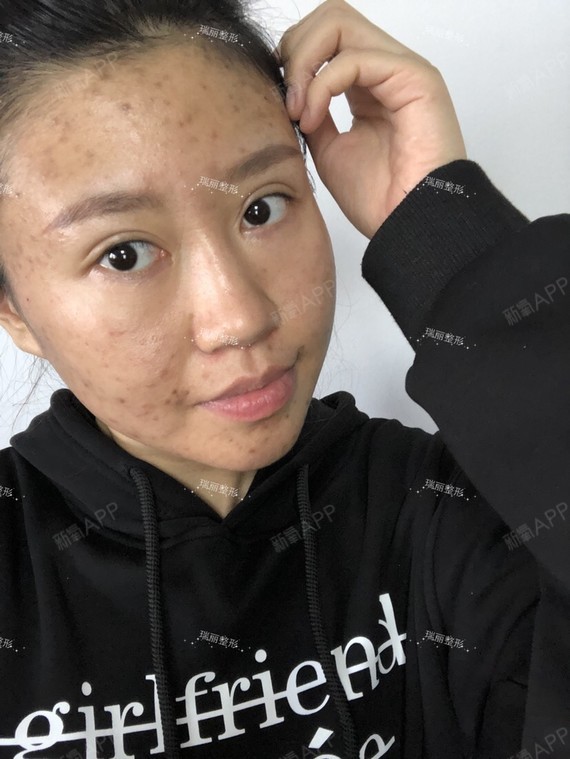 黑龙江瑞丽像素激光祛痘坑痘印