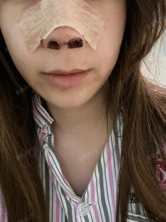 隆鼻鼻子_鼻子隆鼻手术图片_鼻子隆鼻后多久恢复正常