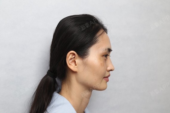 今天我去时光找了郑医生做了筋膜隆鼻复合耳甲艇鼻尖重_圈子-新氧美容