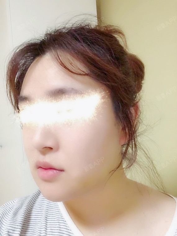 下巴截骨前移