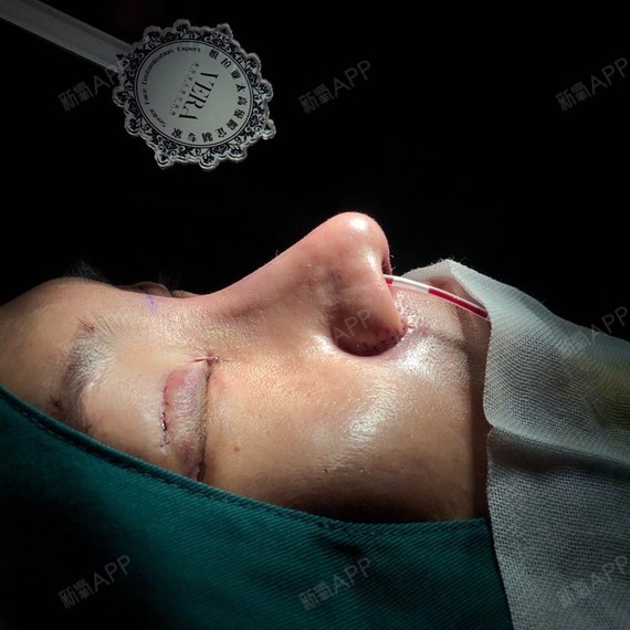 天津假体垫鼻基底好不好_效果图_氧气2pl10假体垫鼻基底术后第0天